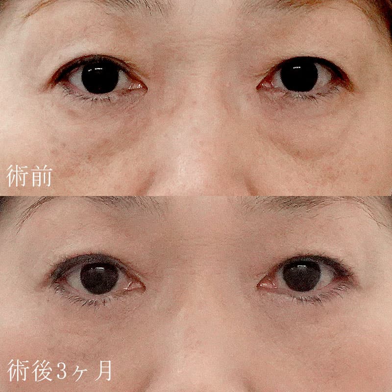 金子医師のハムラ法の症例写真②