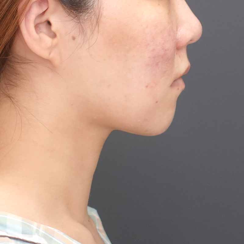 20250407_ N29797_nisikawa_face-liposuction_philtrum-botox②After