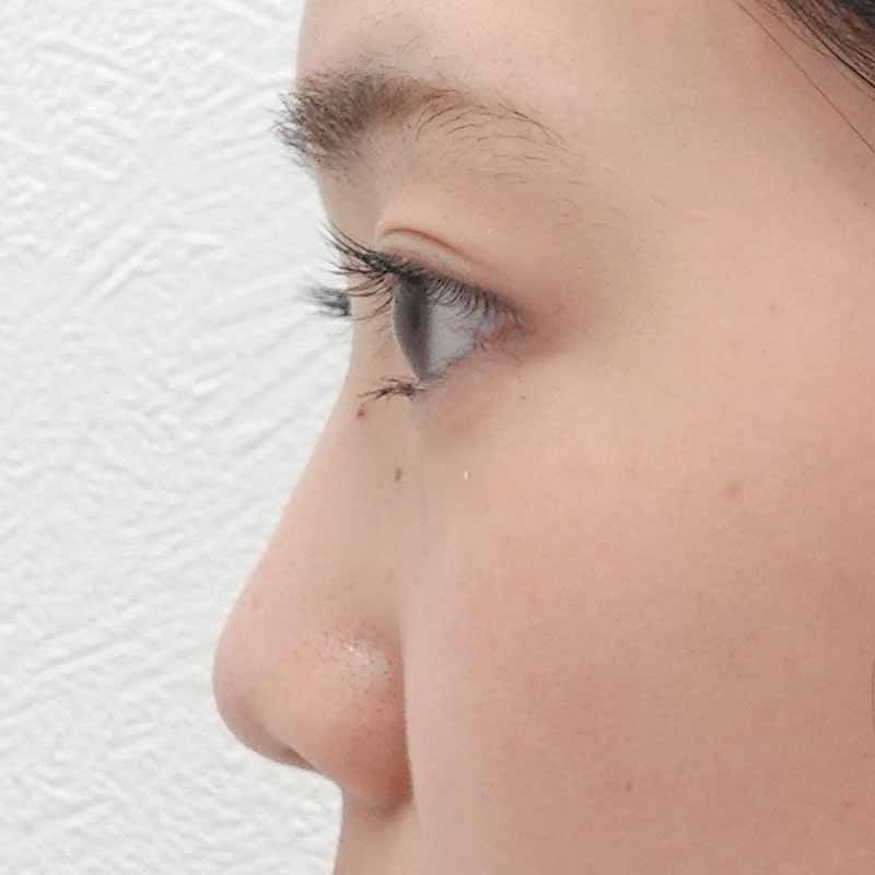 20250407_ S20327_ota_hyaluronic nose①After