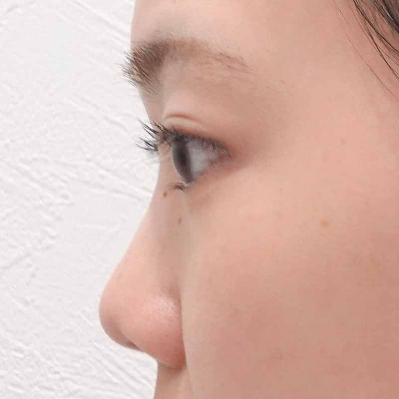 20250407_ S20327_ota_hyaluronic nose①Before
