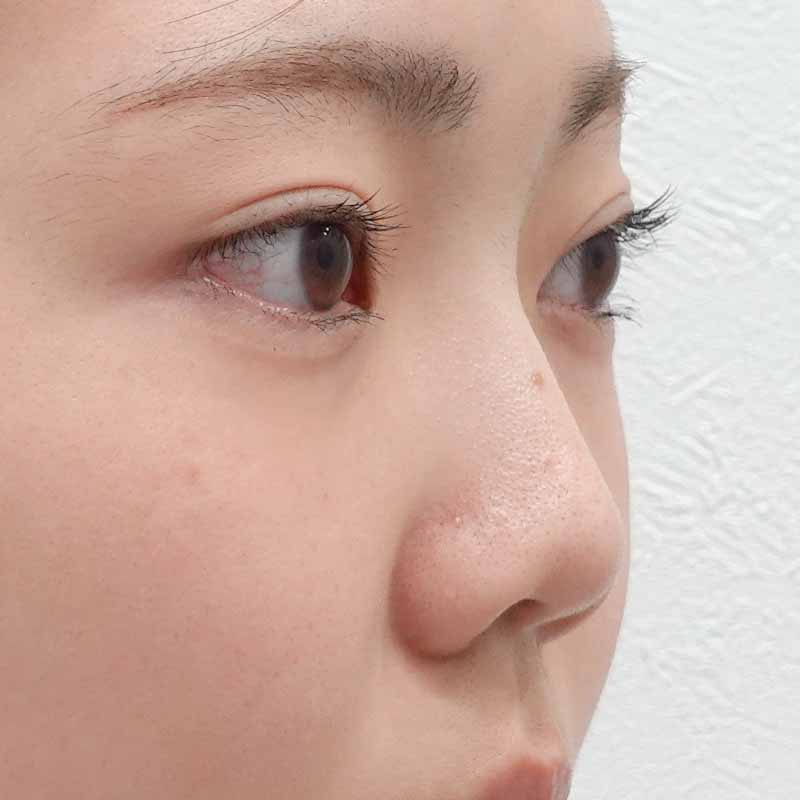 20250407_ S20327_ota_hyaluronic nose②After
