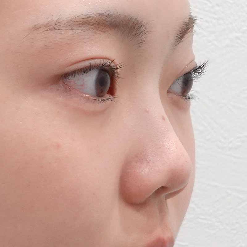 20250407_ S20327_ota_hyaluronic nose②Before