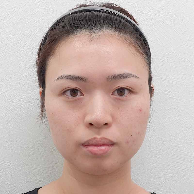 20250407_G111198_koito_hyaluronic nose①Before