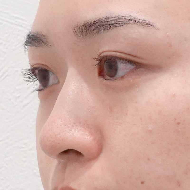20250407_G111198_koito_hyaluronic nose②After