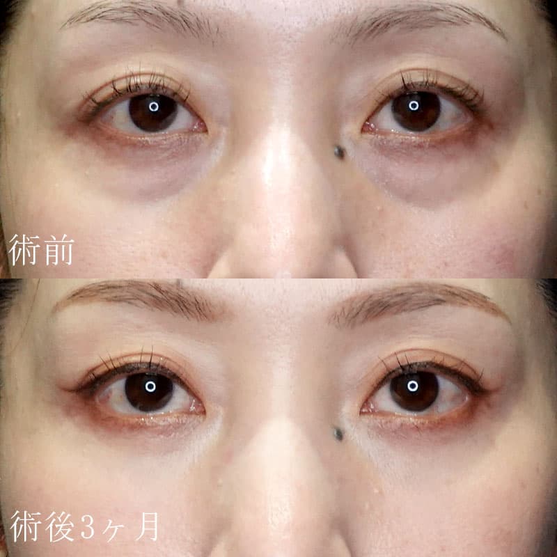 裏ハムラ法症例写真