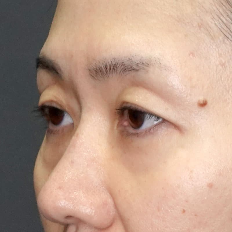 20250420_G116334_nakamura_under-eyebrow incision①Before