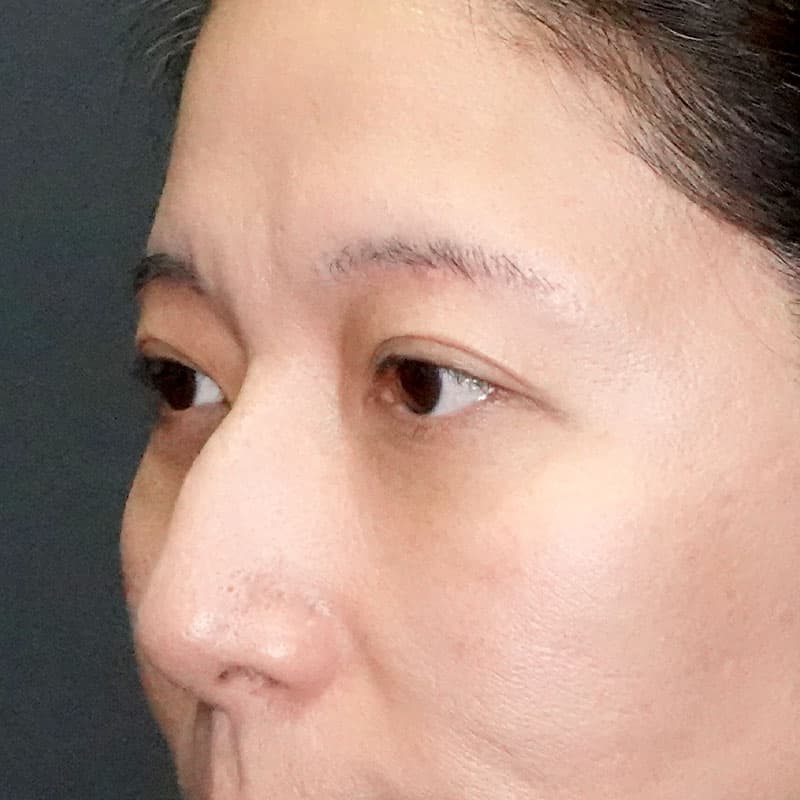 20250420_G22160_nakamura_under-eyebrow incision①After