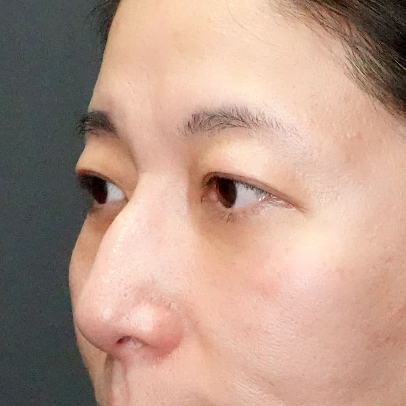 20250420_G22160_nakamura_under-eyebrow incision①Before
