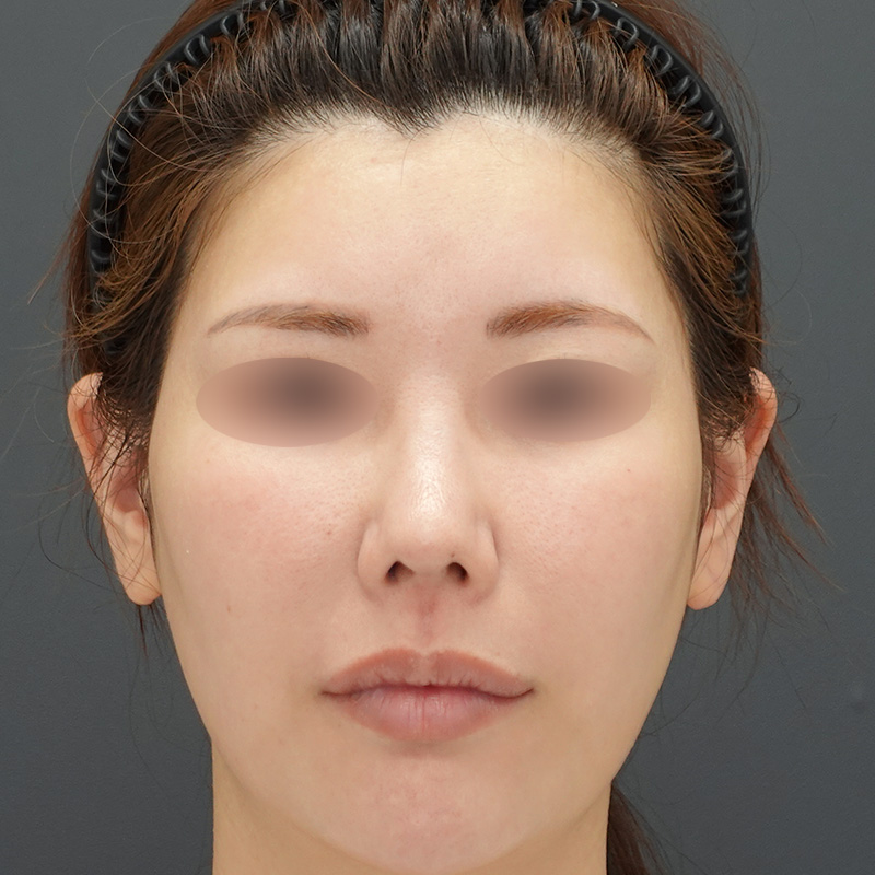 20250422_st9_nasalseptum-extension②After