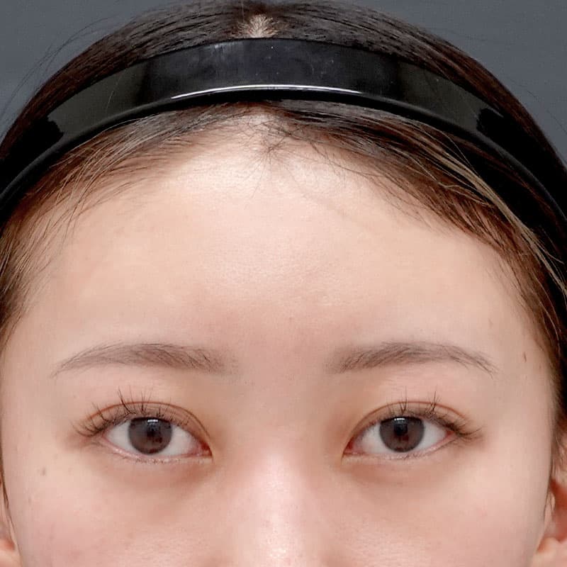 20250427_N115532_matori_hyaluronic forehead①After