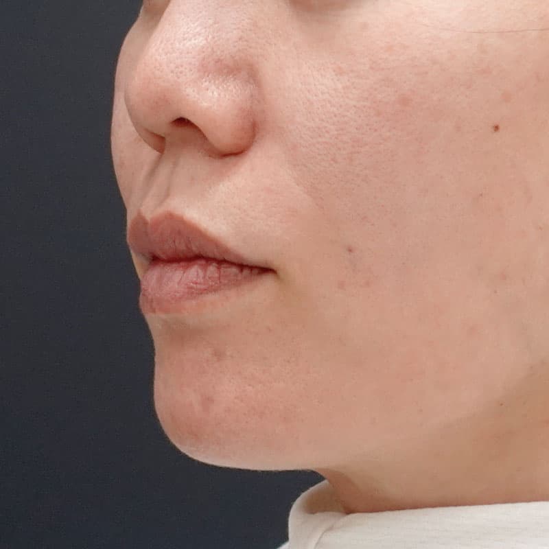 20250427_N123367_matori_hyaluronic nasolabial folds①After