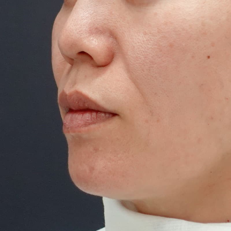 20250427_N123367_matori_hyaluronic nasolabial folds①Before