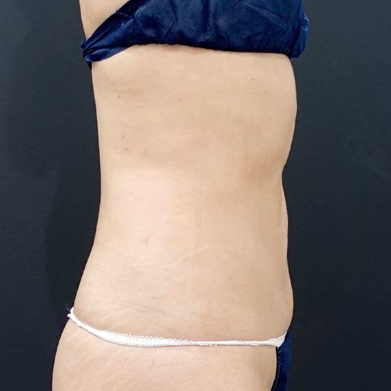 20250430_F3983_kaneko_stomach-liposuction①After