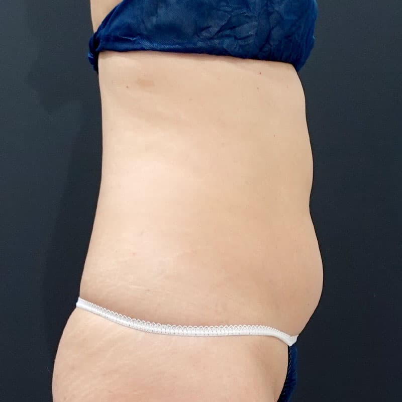 20250430_F3983_kaneko_stomach-liposuction①Before