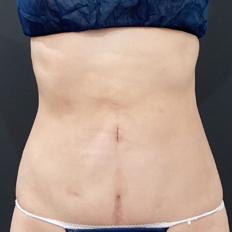 20250430_F3983_kaneko_stomach-liposuction②After
