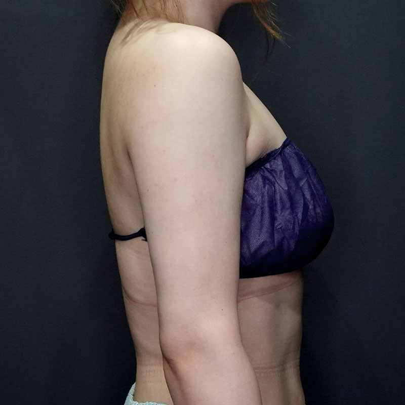 20250430_G41400_ishihara_arm-liposuction①After