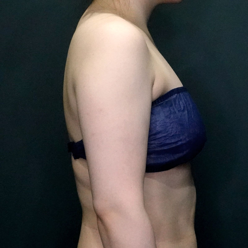 20250430_G41400_ishihara_arm-liposuction①Before