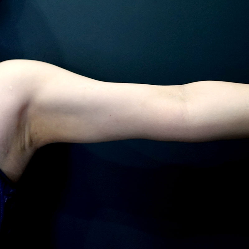 20250430_G41400_ishihara_arm-liposuction②After