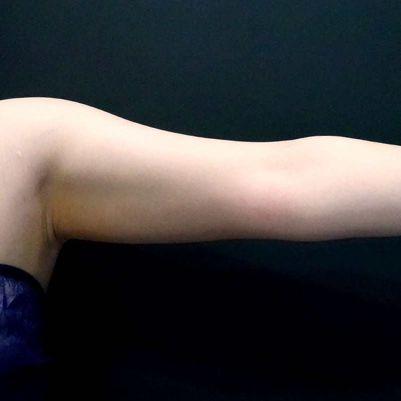 20250430_G41400_ishihara_arm-liposuction②Before