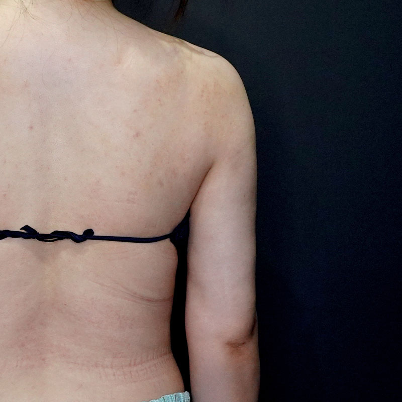20250430_G41400_ishihara_arm-liposuction③After