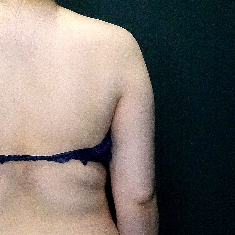 20250430_G41400_ishihara_arm-liposuction③Before