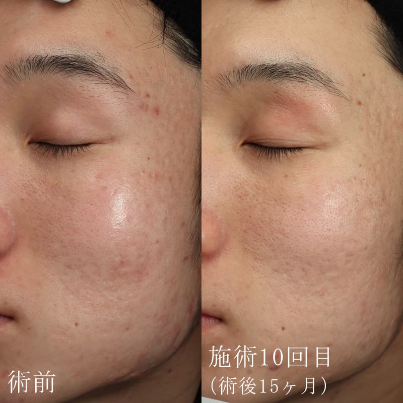 20250416_N42587_dermapenメイン縦