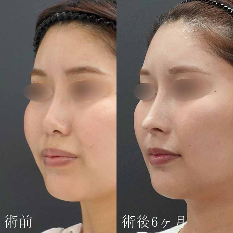 鼻中隔延長＋肋軟骨移植