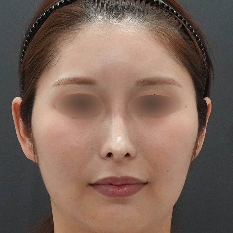 20250422_S20250422-2_nasalseptum-extension①After