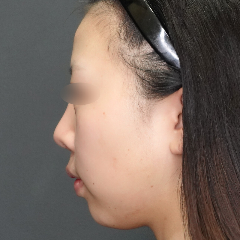 20250422_S20250422_nasalseptum-extension①After