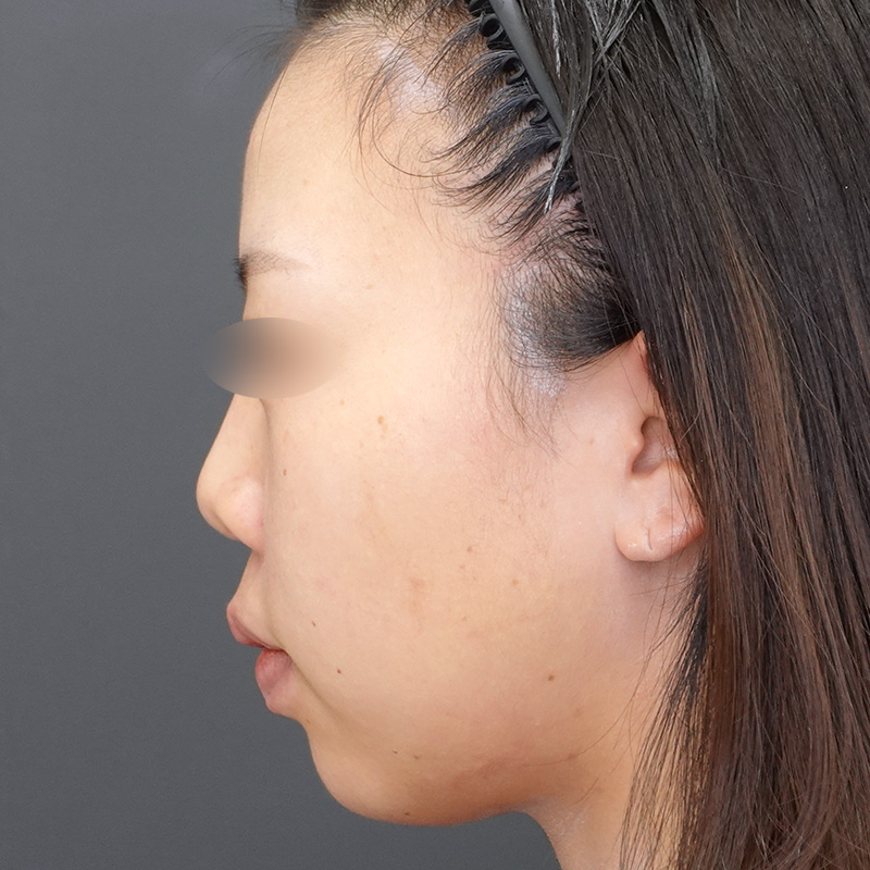 20250422_S20250422_nasalseptum-extension①Before