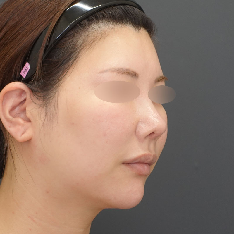 20250422_st9_nasalseptum-extension - S①After