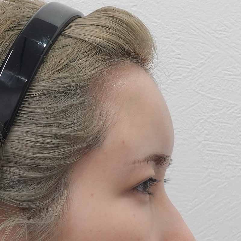 20250508_ G34330_ono_hyaluronic forehead①After