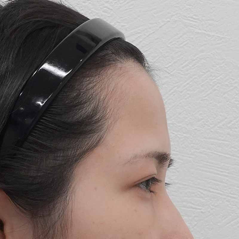 20250508_ G34330_ono_hyaluronic forehead①Before