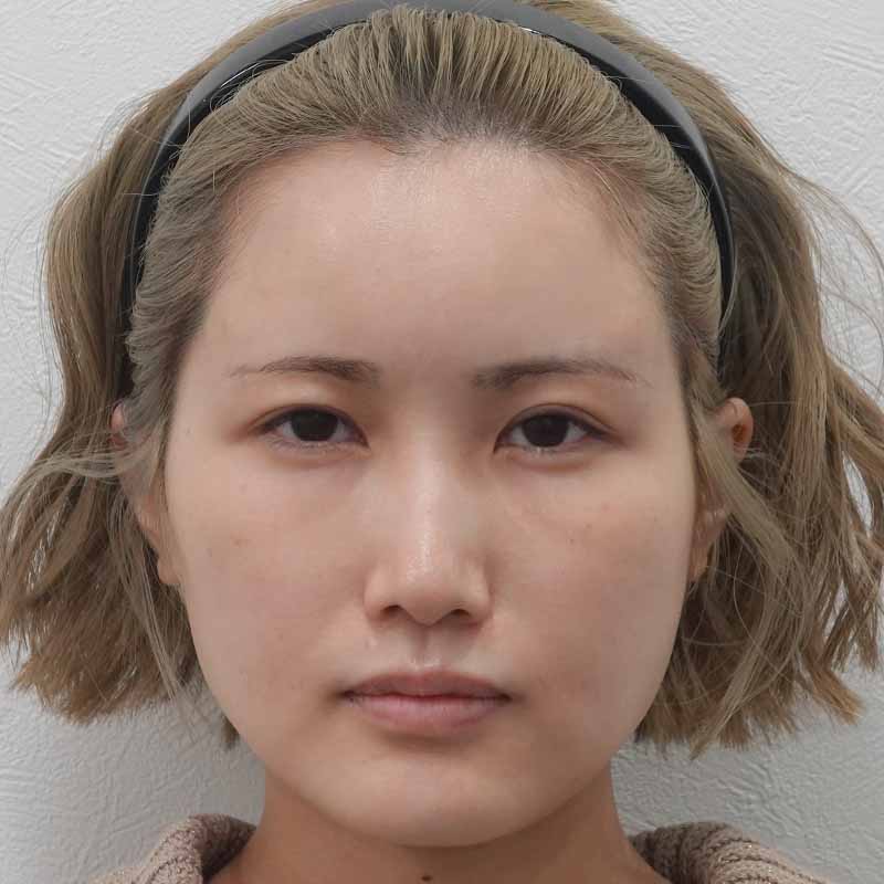 20250508_ G34330_ono_hyaluronic forehead②After