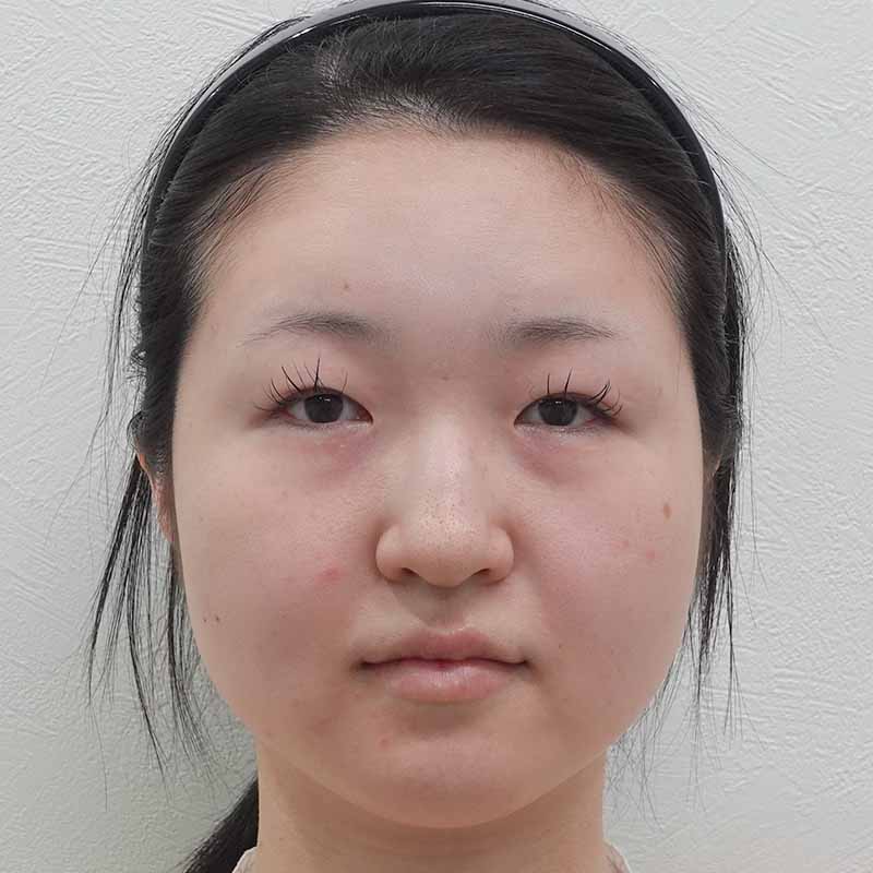 20250508_ N38964_ono_hyaluronic forehead①After