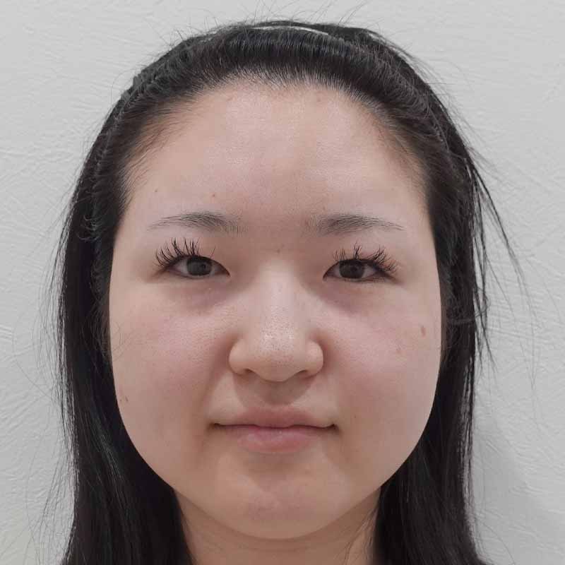 20250508_ N38964_ono_hyaluronic forehead①Before