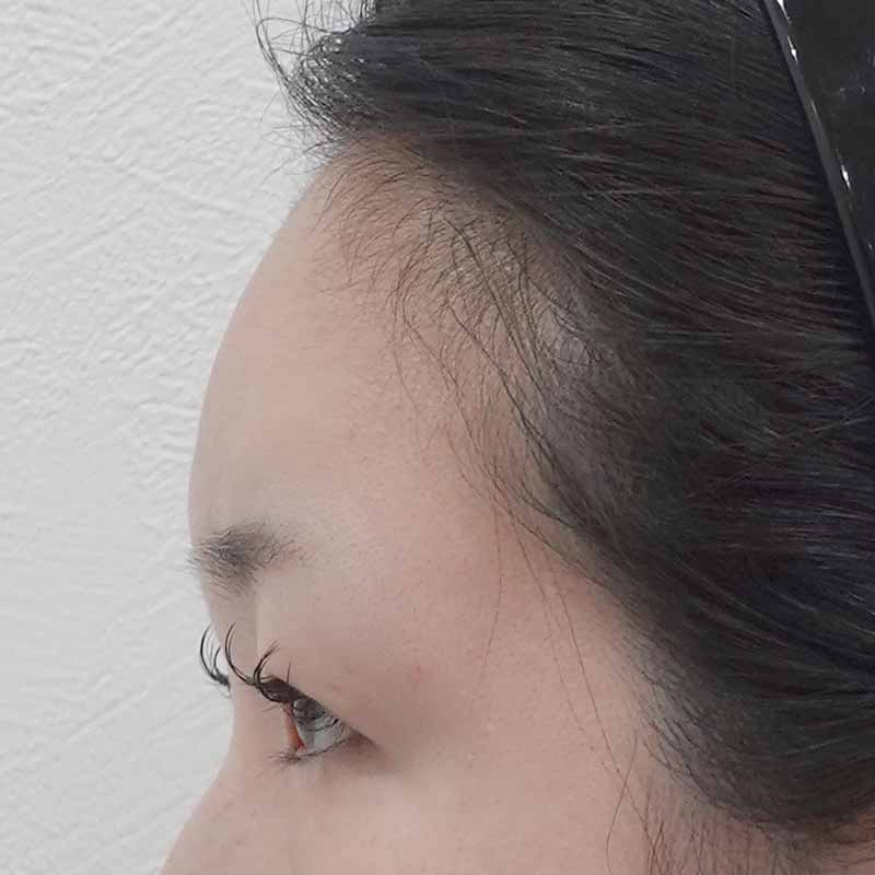 20250508_ N38964_ono_hyaluronic forehead③After