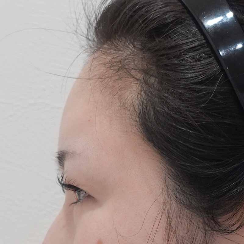 20250508_ N38964_ono_hyaluronic forehead③Before