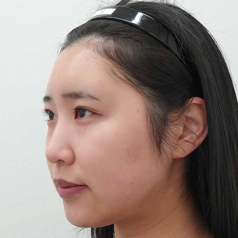 20250508_ S27936_ono_hyaluronic forehead①After