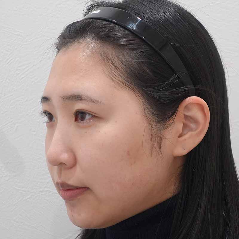 20250508_ S27936_ono_hyaluronic forehead①Before