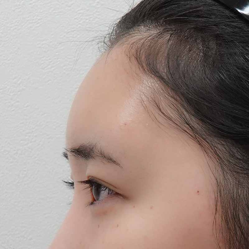 20250508_ S27936_ono_hyaluronic forehead②After