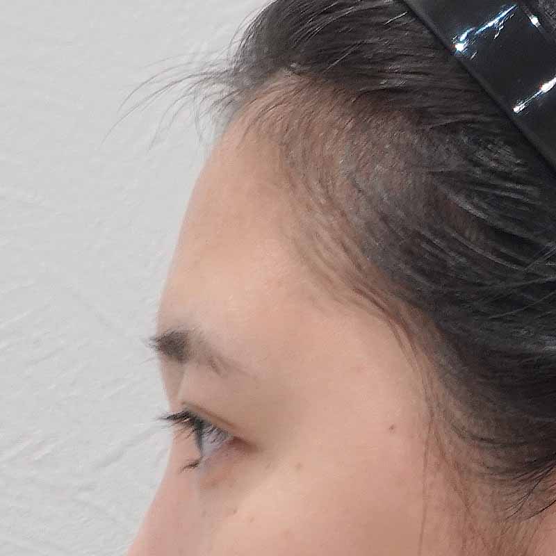 20250508_ S27936_ono_hyaluronic forehead②Before