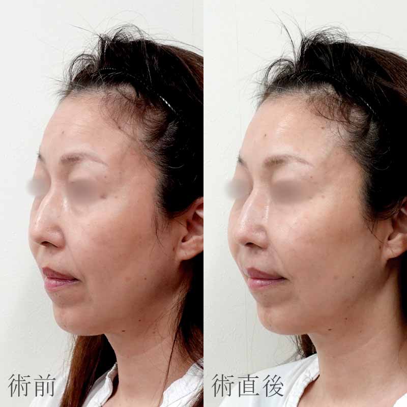 20250508_S104224_tukahara_hyaluronic acid liftメイン縦