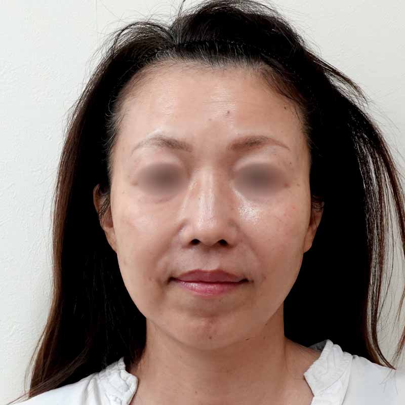20250508_S104224_tukahara_hyaluronic acid lift①After