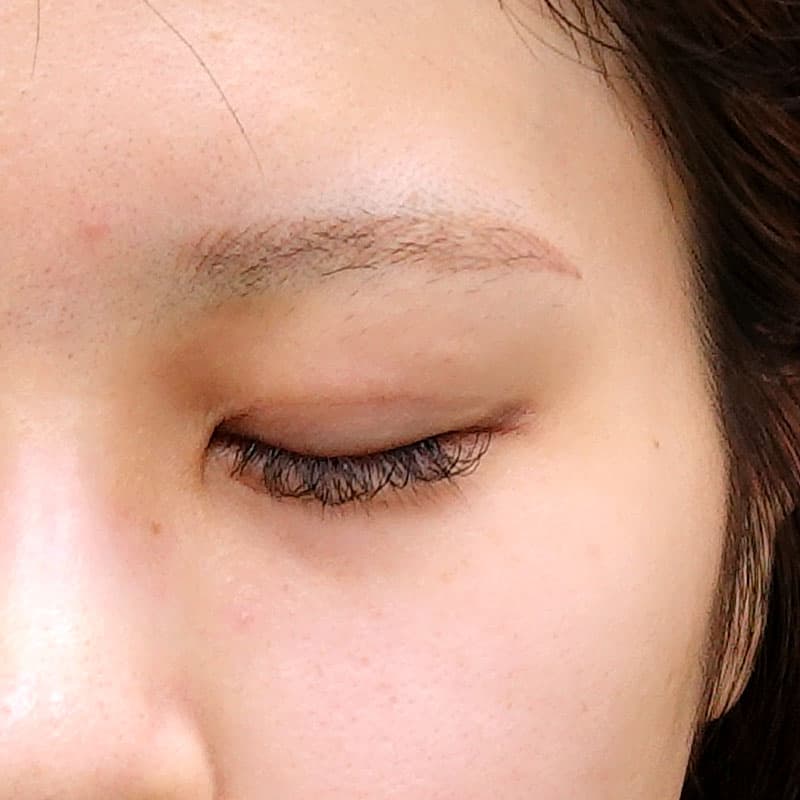20250525_O126436_sugishima_double-burial-method hyaluronic eye bags①After