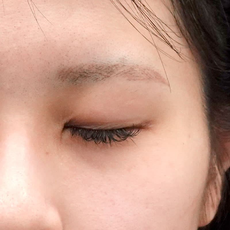 20250525_O126436_sugishima_double-burial-method hyaluronic eye bags①Before