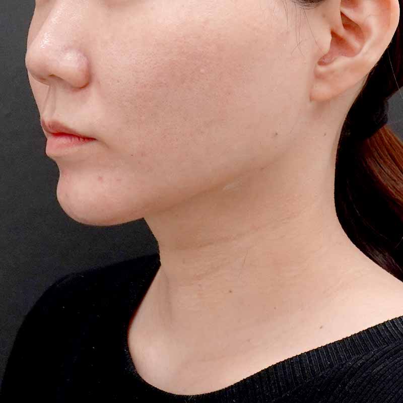 20250531_ G119407_hurumura_face-liposuction_philtrum-botox①After