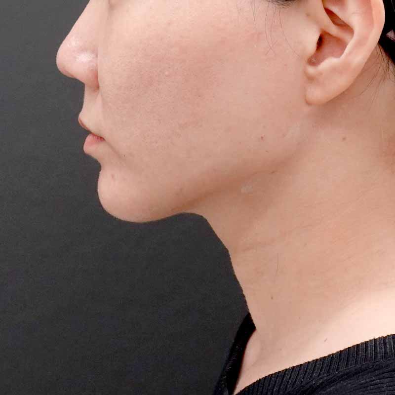 20250531_ G119407_hurumura_face-liposuction_philtrum-botox②After