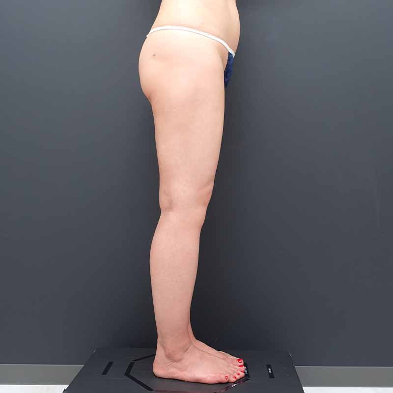 20250531_ N171783_tukahara_thigh-liposuction①After