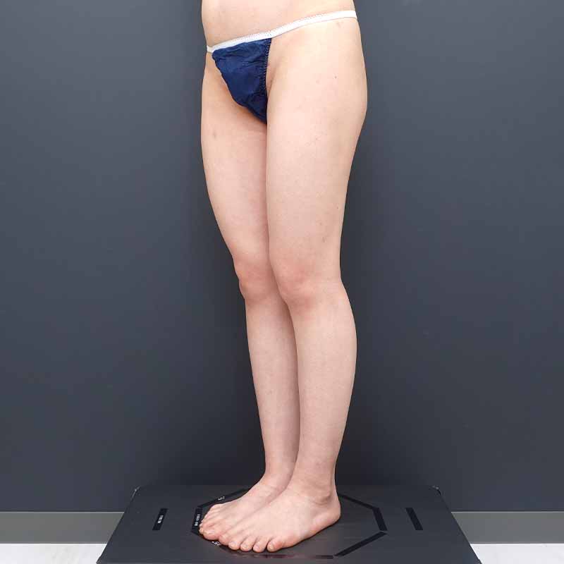 20250531_ N171783_tukahara_thigh-liposuction①After